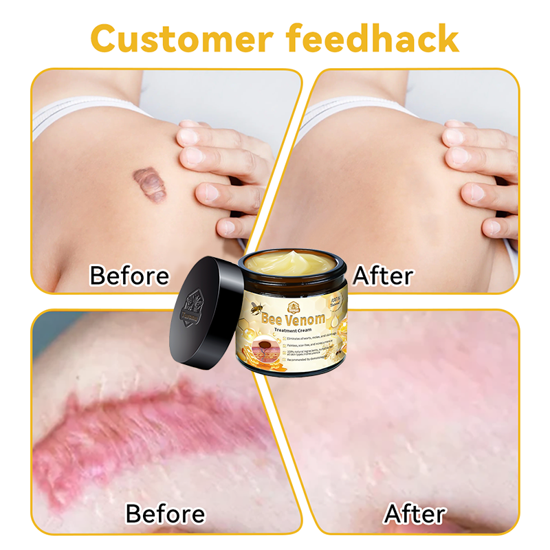 🏪𝑇𝑢𝑟𝑜𝑛𝑢™ Bee Venom Skin Treatment Cream(𝐴𝐴𝐷 𝑅𝑒𝑐𝑜𝑚𝑚𝑒𝑛𝑑𝑒𝑑)