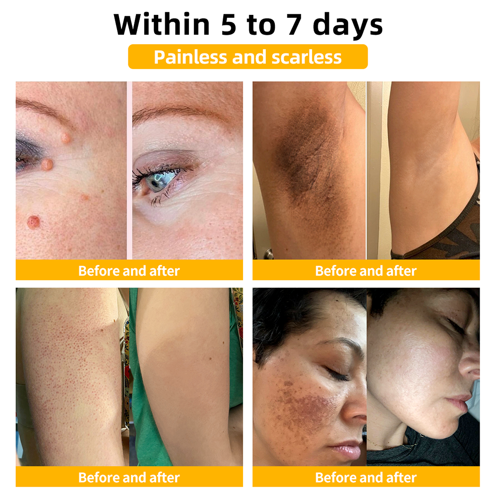 🏪𝑇𝑢𝑟𝑜𝑛𝑢™ Bee Venom Skin Treatment Cream(𝐴𝐴𝐷 𝑅𝑒𝑐𝑜𝑚𝑚𝑒𝑛𝑑𝑒𝑑)